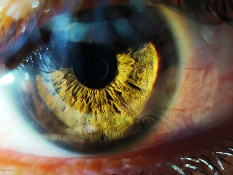 Alergia Ocular Tratamento Eficaz em São José dos Pinhais